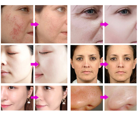 Aesthetic Oxygen Jet Aqua Peel Facial 7 in 1 Hydro Micro Dermabrasion Oxigen Hydra Microdermabrasion Beauty Machine